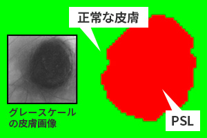 正常な皮膚とPSLのセグメンテーションイメージ図