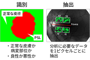 正常な皮膚とPSLのセグメンテーションイメージ図